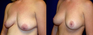 Left 3/4 View - Breast Augmentation with Periareolar Lift - Saline Implants