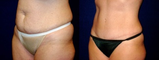 Left 3/4 View - Tummy Tuck After Pregnancy