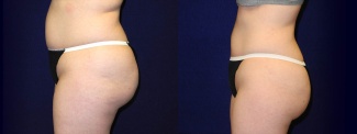 Left Profile View - Liposuction