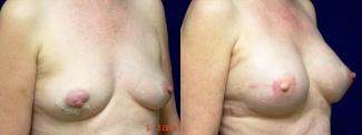 Right 3/4 View - Breast Reconstruction