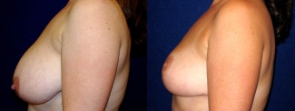 Left Profile View - Breast Reduction