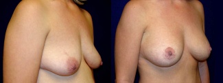 Right 3/4 View - Breast Augmentation with Periareolar Lift - Saline Implants