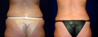 Back View - Tummy Tuck After Pregnancy