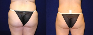 Back View - Liposuction