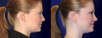 Right Profile View - Otoplasty