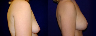 Right Profile View - Breast Augmentation with Periareolar Lift - Saline Implants