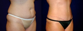 Right 3/4 View - Tummy Tuck After Pregnancy