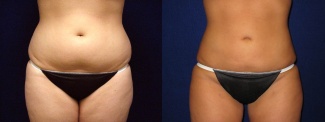 Frontal View - Liposuction