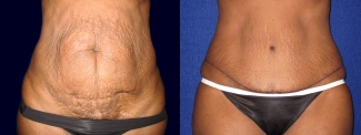 Frontal View - Tummy Tuck After Pregnancy