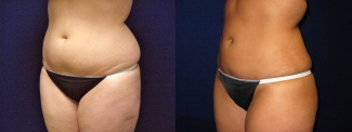 Left 3/4 View -Liposuction