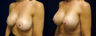 Left 3/4 View - Breast Implant Revision - Silicone Implants