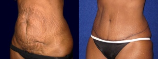 Left 3/4 View - Tummy Tuck After Pregnancy