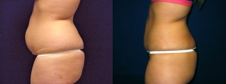 Left Profile View - Liposuction