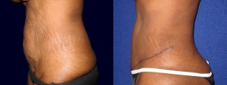 Left Profile View - Tummy Tuck After Pregnancy