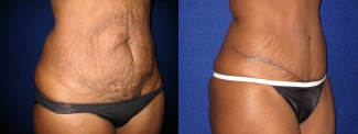 Right 3/4 View - Tummy Tuck After Pregnancy