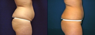 Right Profile View - Liposuction