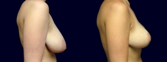 Right Profile View - Breast Lift