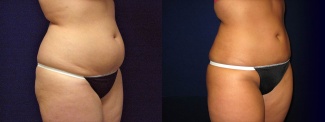 Right 3/4 View - Liposuction