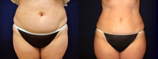 Frontal View - Liposuction