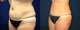 Left 3/4 View -Liposuction