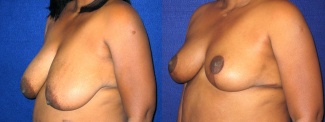 Left 3/4 View - Breast Reconstruction