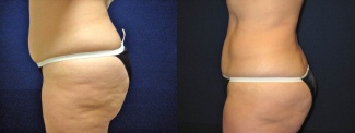 Left Profile View - Liposuction