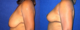 Left Profile View - Breast Reconstruction