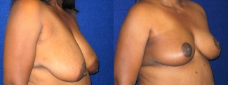 Right 3/4 View - Breast Reconstruction