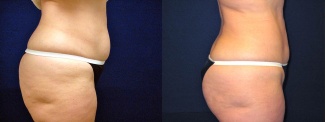 Right Profile View - Liposuction