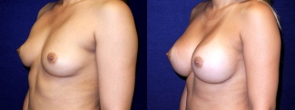 Left 3/4 View - Breast Augmentation - Silicone Implants