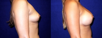 Right Profile View - Breast Augmentation - Silicone Implants