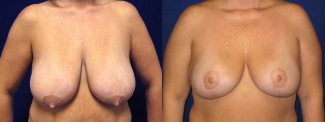 Frontal View - Breast Reduction