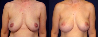 Frontal View - Breast Reconstruction