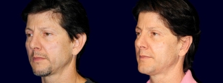 Left 3/4 View - Otoplasty with Chin Augmentation