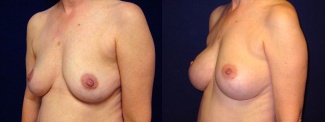 Left 3/4 View - Breast Reconstruction