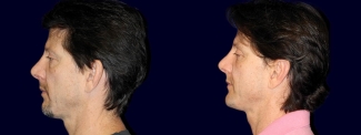 Left Profile View - Otoplasty with Chin Augmentation