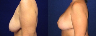 Left Profile View - Breast Reduction