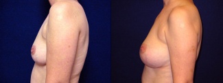 Left Profile View - Breast Reconstruction