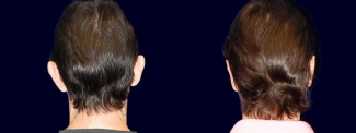 Back View - Otoplasty with Chin Augmentation