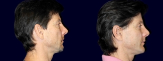 Right Profile View - Otoplasty with Chin Augmentation