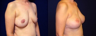 Right 3/4 View - Breast Reconstruction