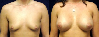 Frontal View - Breast Augmentation - Silicone Implants