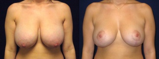 Frontal View - Breast Reduction