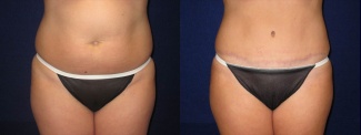 Frontal View - Tummy Tuck After Pregnancy