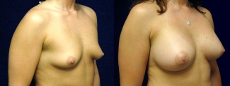 Right 3/4 View - Breast Augmentation - Silicone Implants