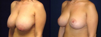 Left 3/4 View - Breast Reduction