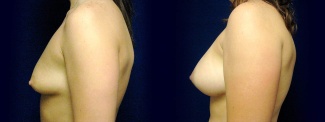 Left Profile View - Breast Augmentation - Silicone Implants