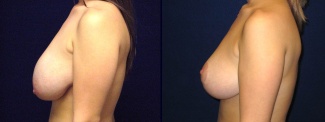 Left Profile View - Breast Reduction