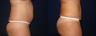 Right Profile View - Tummy Tuck After Pregnancy