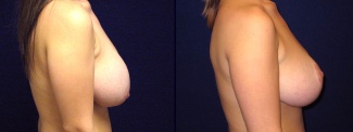 Right Profile View - Breast Reduction